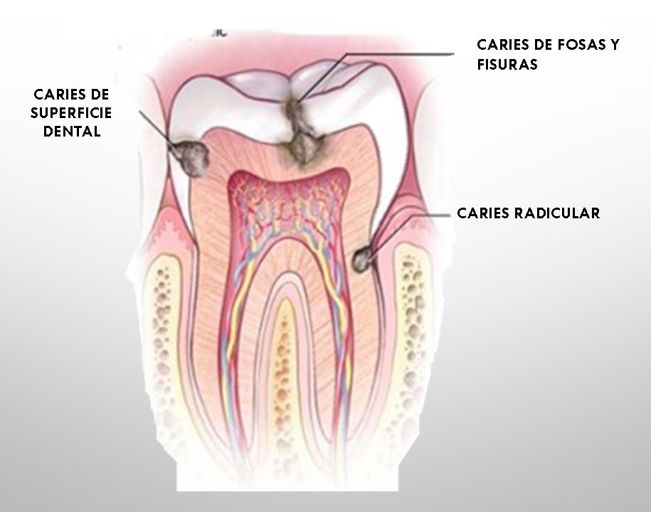 Tipos de Caries
