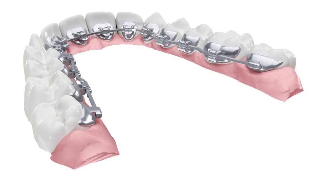 Brackets Invisibles