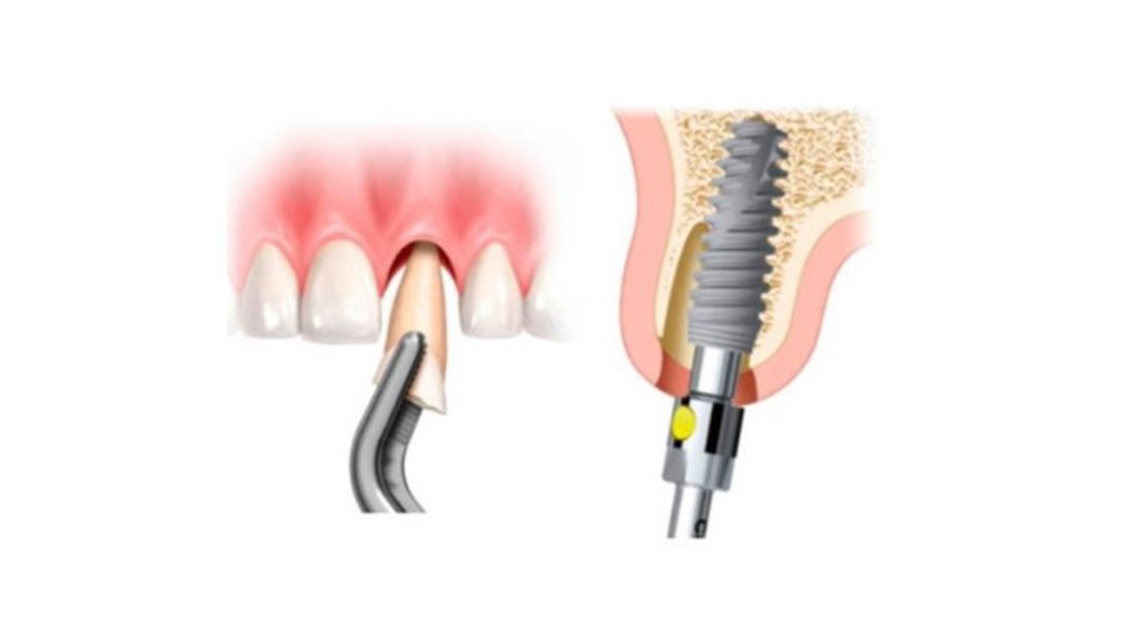 Implantes dentales