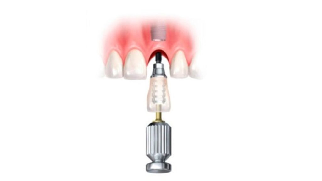 Implantes dentales en 2 Fases