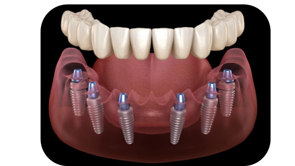 Implantes dentales en Ica