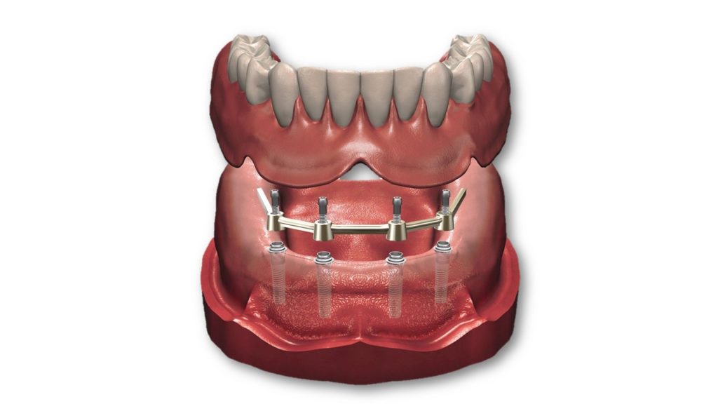 Implantes dentales en Chincha