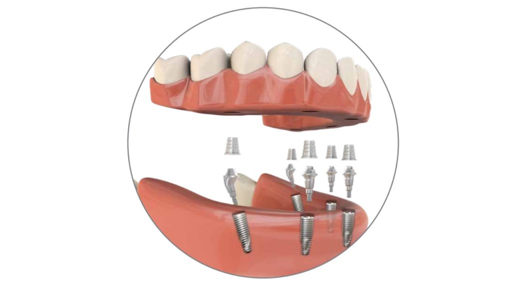 Implantes dentales en Chincha