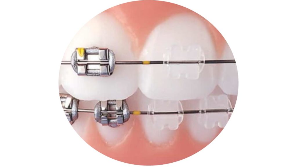 Brackets Metálicos