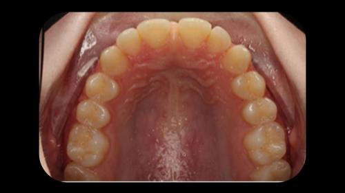 OCLUSAL DIASTEMA ANTERIOR