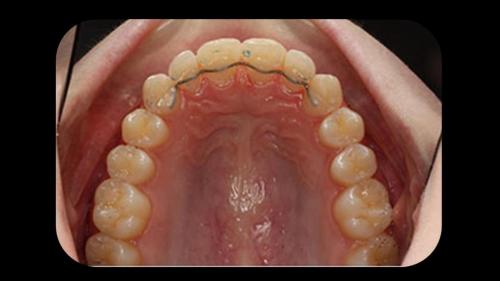 OCLUSAL CIERRE DE DIASTEMA